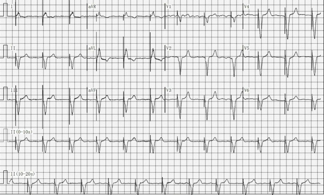 为什么双极不起博只会看常规心电图？远不够，这 4 种起搏心电图你会看吗？｜ 上海心律失常论坛_https://www.jmylbn.com_新闻资讯_第18张