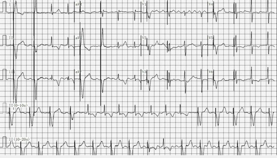 为什么双极不起博只会看常规心电图？远不够，这 4 种起搏心电图你会看吗？｜ 上海心律失常论坛_https://www.jmylbn.com_新闻资讯_第21张