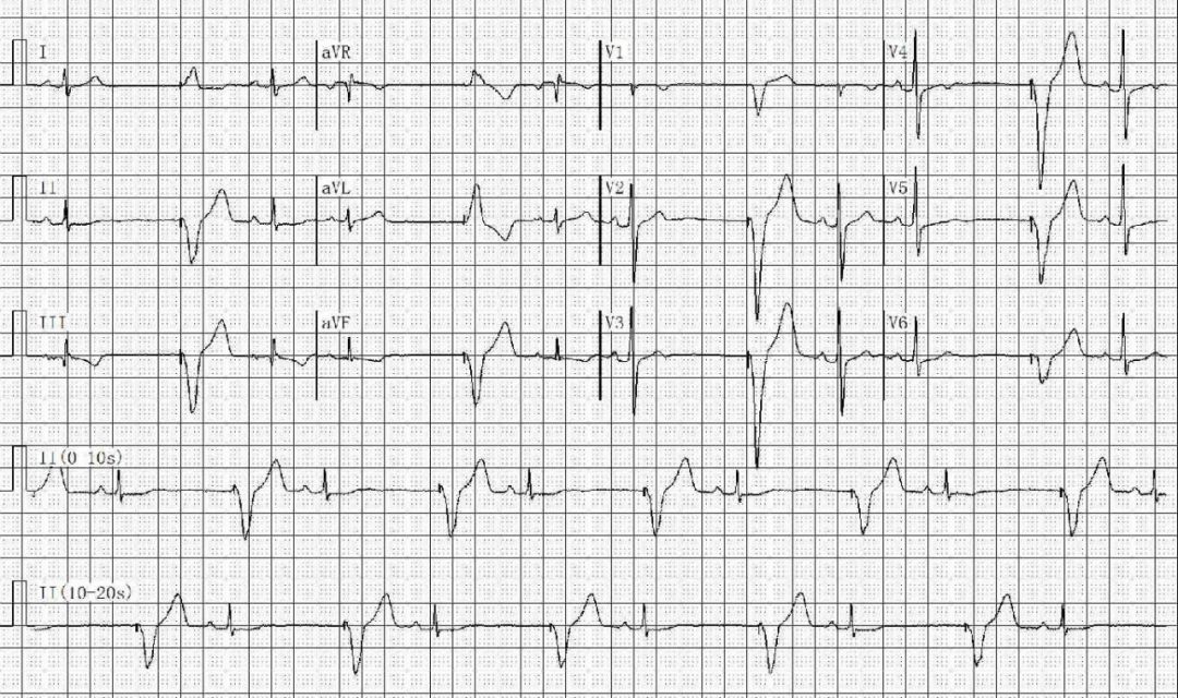 为什么双极不起博只会看常规心电图？远不够，这 4 种起搏心电图你会看吗？｜ 上海心律失常论坛_https://www.jmylbn.com_新闻资讯_第16张