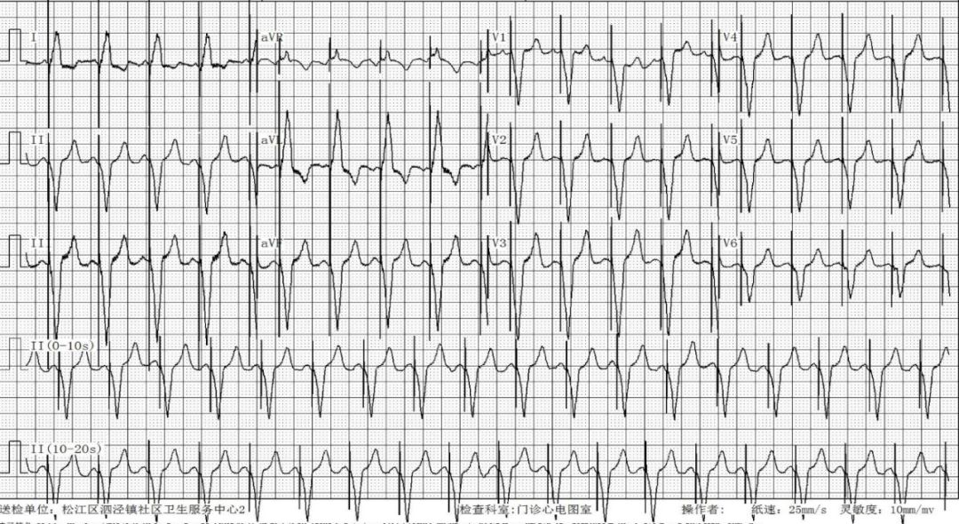 为什么双极不起博只会看常规心电图？远不够，这 4 种起搏心电图你会看吗？｜ 上海心律失常论坛_https://www.jmylbn.com_新闻资讯_第12张