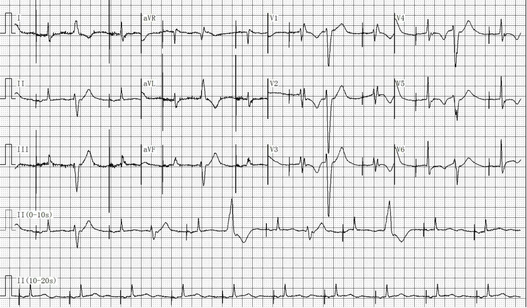 为什么双极不起博只会看常规心电图？远不够，这 4 种起搏心电图你会看吗？｜ 上海心律失常论坛_https://www.jmylbn.com_新闻资讯_第9张