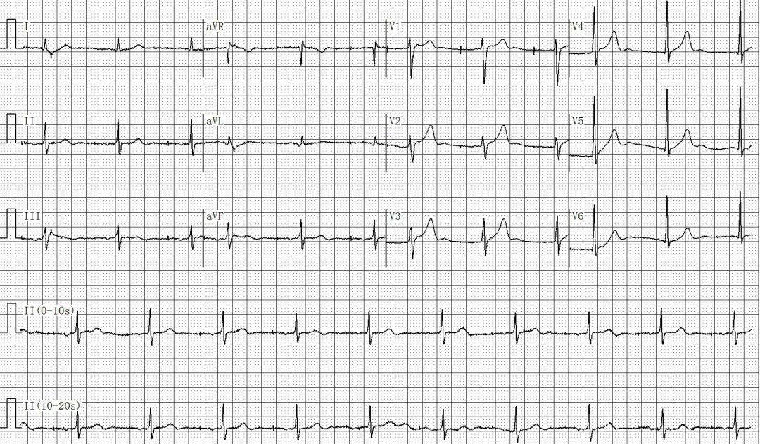 为什么双极不起博只会看常规心电图？远不够，这 4 种起搏心电图你会看吗？｜ 上海心律失常论坛_https://www.jmylbn.com_新闻资讯_第8张