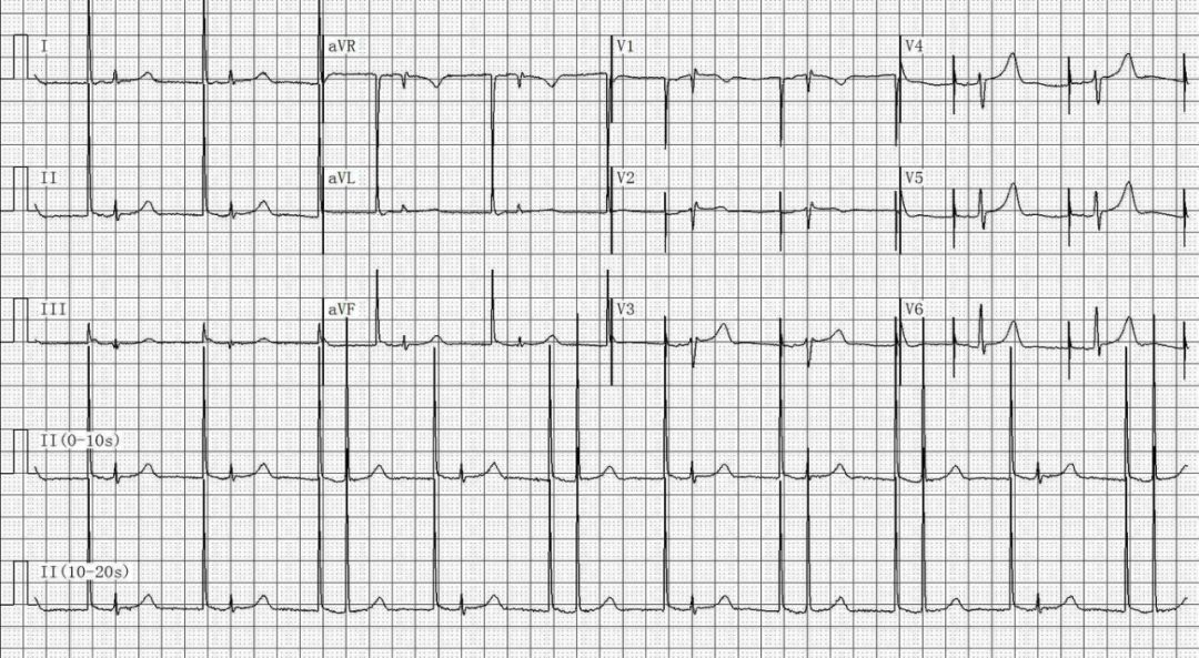 为什么双极不起博只会看常规心电图？远不够，这 4 种起搏心电图你会看吗？｜ 上海心律失常论坛_https://www.jmylbn.com_新闻资讯_第24张