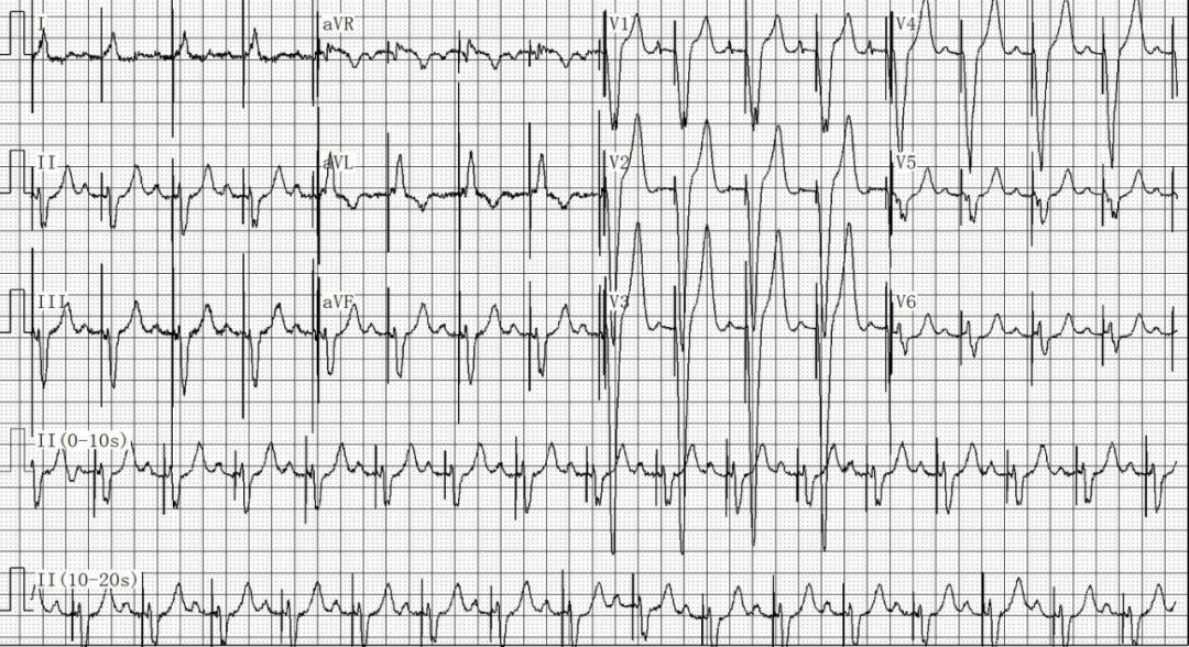 为什么双极不起博只会看常规心电图？远不够，这 4 种起搏心电图你会看吗？｜ 上海心律失常论坛_https://www.jmylbn.com_新闻资讯_第10张