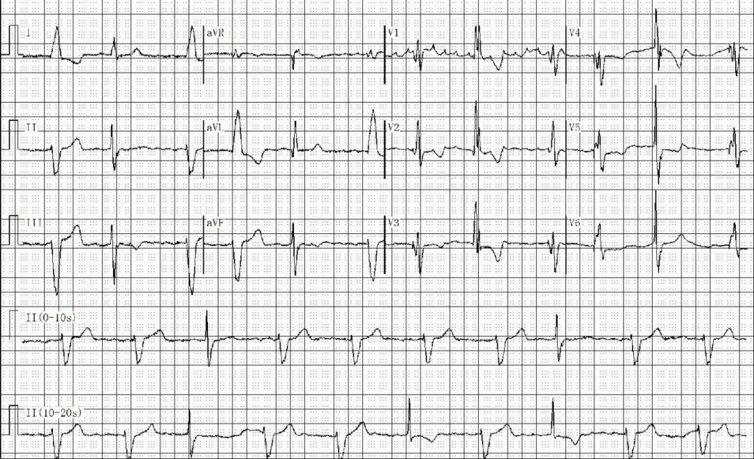 为什么双极不起博只会看常规心电图？远不够，这 4 种起搏心电图你会看吗？｜ 上海心律失常论坛_https://www.jmylbn.com_新闻资讯_第19张
