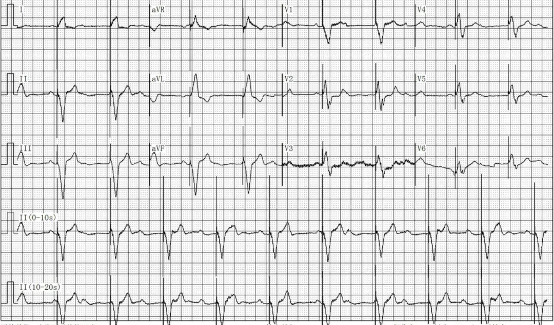为什么双极不起博只会看常规心电图？远不够，这 4 种起搏心电图你会看吗？｜ 上海心律失常论坛_https://www.jmylbn.com_新闻资讯_第17张
