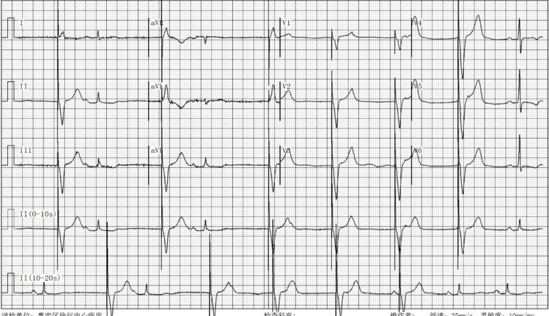 为什么双极不起博只会看常规心电图？远不够，这 4 种起搏心电图你会看吗？｜ 上海心律失常论坛_https://www.jmylbn.com_新闻资讯_第14张