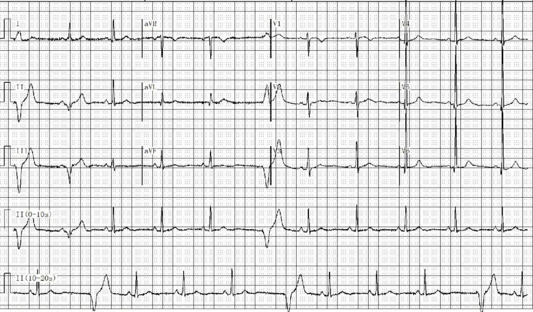 为什么双极不起博只会看常规心电图？远不够，这 4 种起搏心电图你会看吗？｜ 上海心律失常论坛_https://www.jmylbn.com_新闻资讯_第15张