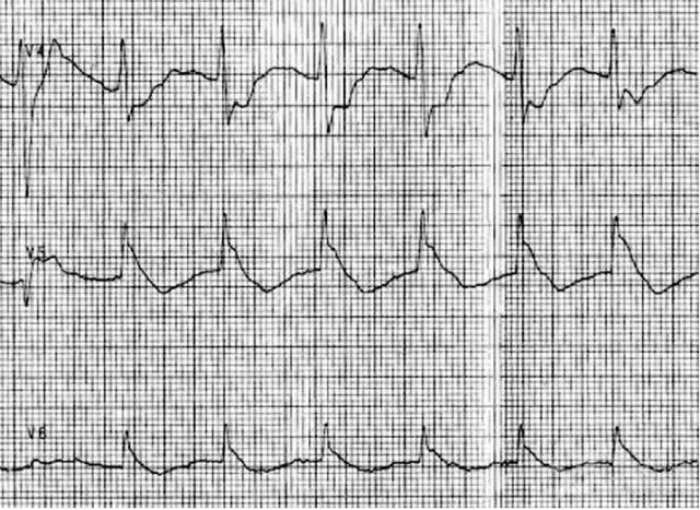 小心！這 9 種心電圖表現提示心梗危重 未分類 第15張