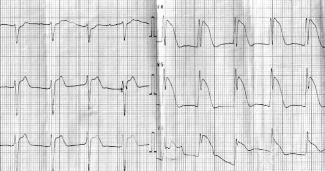 小心！這 9 種心電圖表現提示心梗危重 未分類 第12張