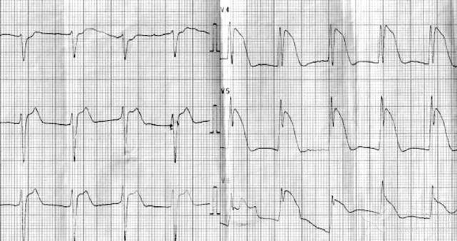 小心！這 9 種心電圖表現提示心梗危重 健康 第12張