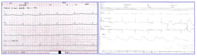 小心！這 9 種心電圖表現提示心梗危重 未分類 第4張