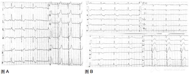 小心！這 9 種心電圖表現提示心梗危重 未分類 第10張