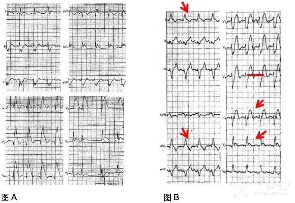 小心！這 9 種心電圖表現提示心梗危重 未分類 第16張