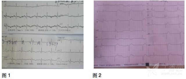 小心！這 9 種心電圖表現提示心梗危重 未分類 第2張