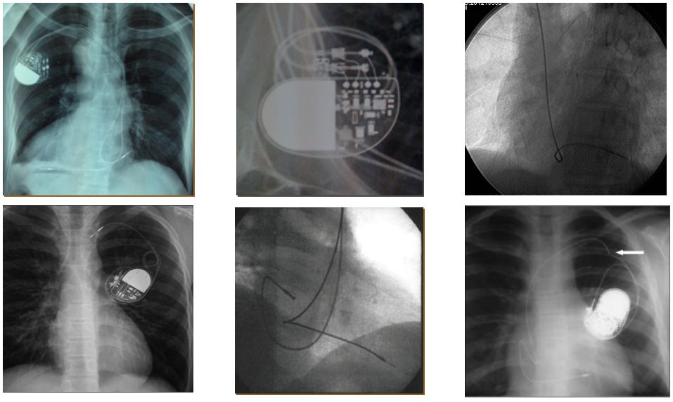 为什么双极不起博起搏器故障怎么办？简单 5 步轻松搞定 ｜ 上海心律失常论坛_https://www.jmylbn.com_新闻资讯_第14张