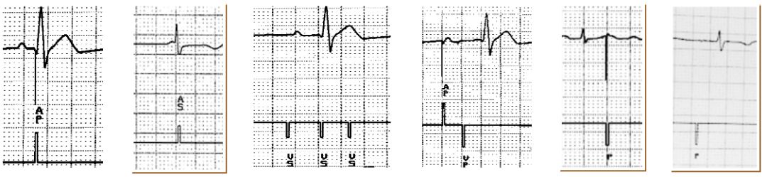 为什么双极不起博起搏器故障怎么办？简单 5 步轻松搞定 ｜ 上海心律失常论坛_https://www.jmylbn.com_新闻资讯_第12张