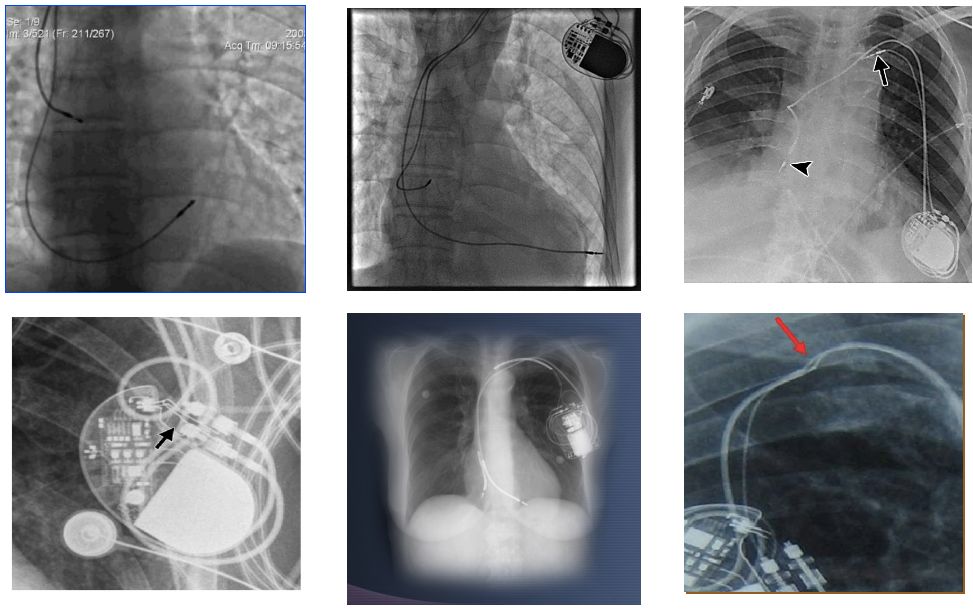 为什么双极不起博起搏器故障怎么办？简单 5 步轻松搞定 ｜ 上海心律失常论坛_https://www.jmylbn.com_新闻资讯_第13张