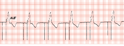 为什么双极不起博起搏器故障怎么办？简单 5 步轻松搞定 ｜ 上海心律失常论坛_https://www.jmylbn.com_新闻资讯_第5张