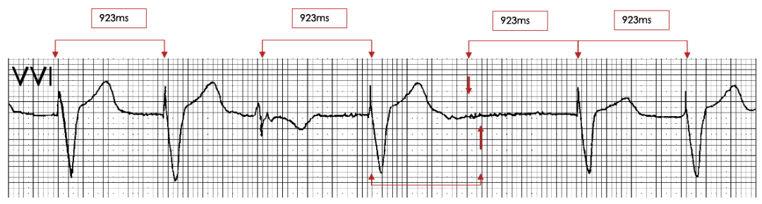 为什么双极不起博起搏器故障怎么办？简单 5 步轻松搞定 ｜ 上海心律失常论坛_https://www.jmylbn.com_新闻资讯_第10张