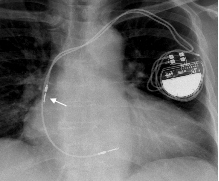 为什么双极不起博起搏器故障怎么办？简单 5 步轻松搞定 ｜ 上海心律失常论坛_https://www.jmylbn.com_新闻资讯_第6张