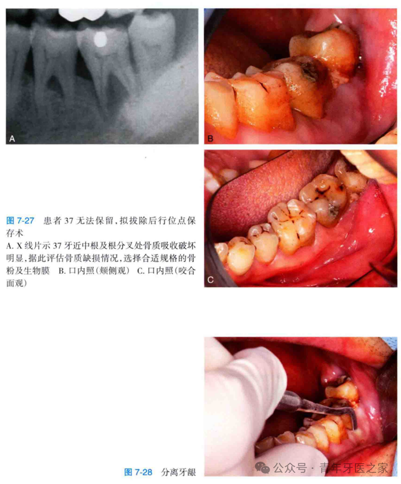 牙拔除术后即刻位点保存术的操作技巧