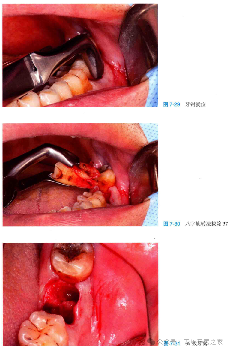 牙拔除术后即刻位点保存术的操作技巧