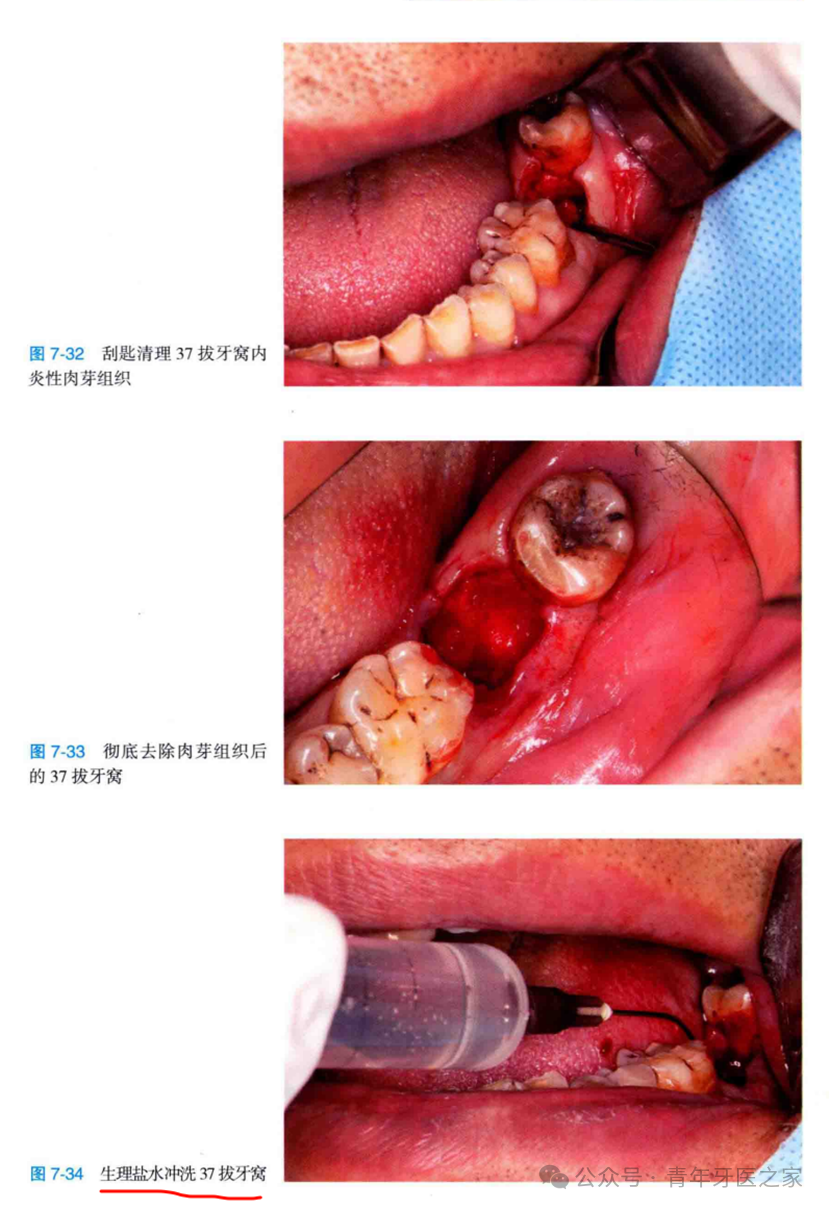 牙拔除术后即刻位点保存术的操作技巧