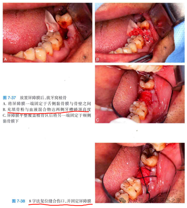牙拔除术后即刻位点保存术的操作技巧