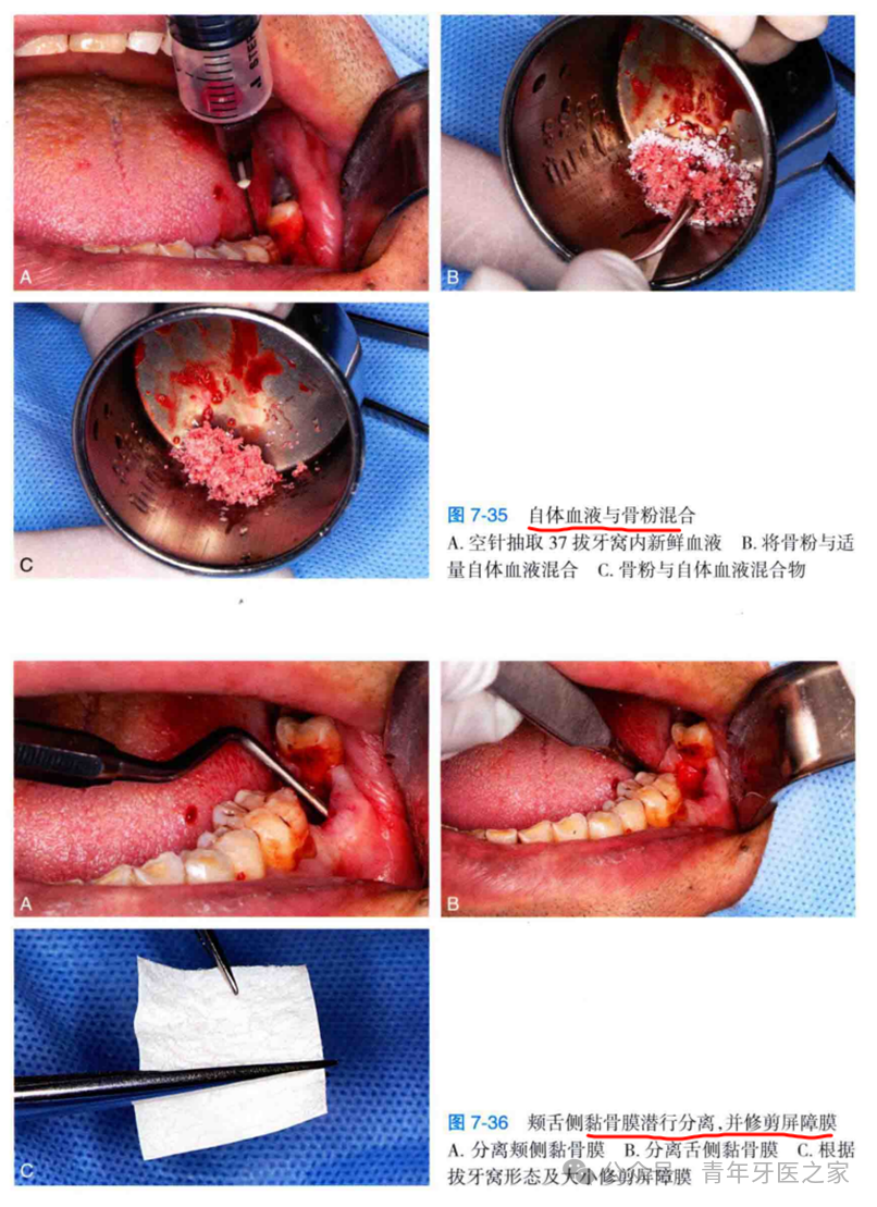 牙拔除术后即刻位点保存术的操作技巧