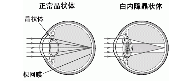 怎么看眼底相机微清Apollo相机，揭开白内障眼底的神秘面纱_https://www.jmylbn.com_新闻资讯_第2张