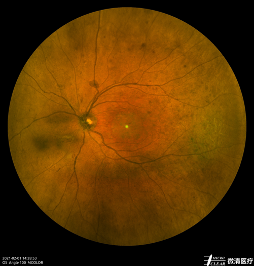 手持眼底相机怎么用“视”关重要——眼底照相检查_https://www.jmylbn.com_新闻资讯_第3张