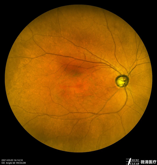 手持眼底相机怎么用“视”关重要——眼底照相检查_https://www.jmylbn.com_新闻资讯_第4张