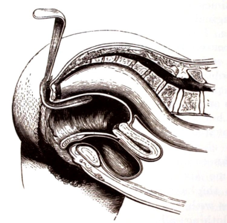 阴道扩张器干什么用妇科检查用的「窥阴器」，你真的了解吗？_https://www.jmylbn.com_新闻资讯_第16张