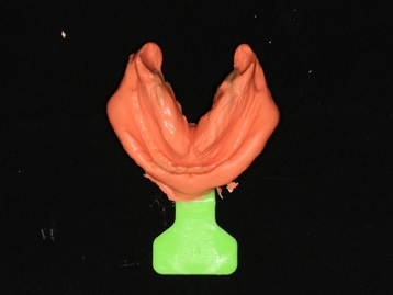 口腔吸盘怎么安装口腔科普丨吸附性全口义齿是什么？_https://www.jmylbn.com_新闻资讯_第9张