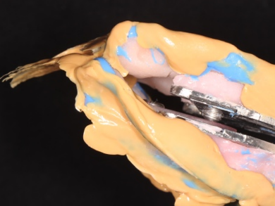 口腔吸盘怎么安装口腔科普丨吸附性全口义齿是什么？_https://www.jmylbn.com_新闻资讯_第10张