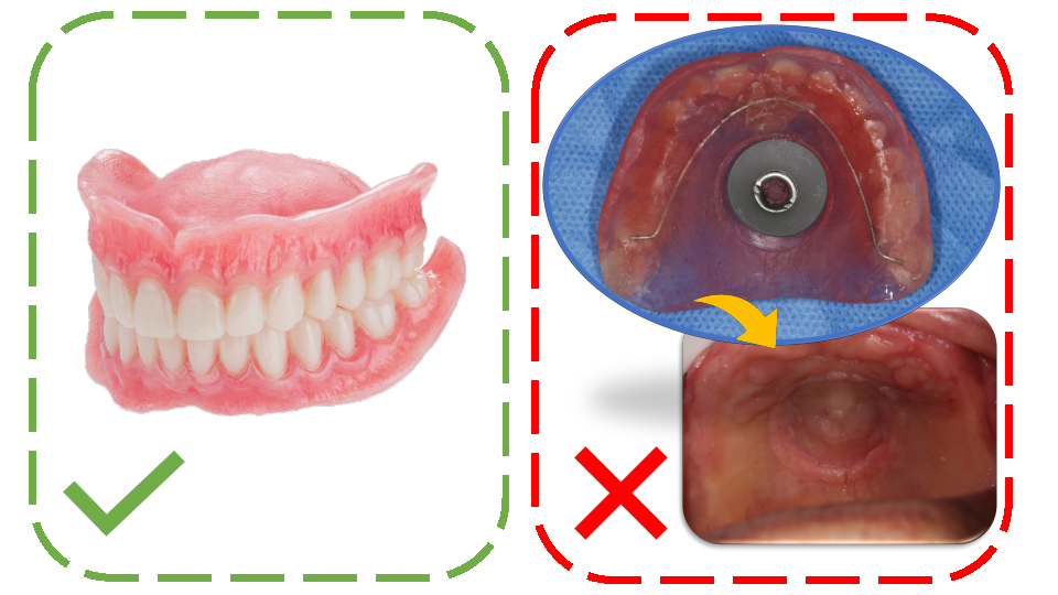 口腔吸盘怎么安装口腔科普丨吸附性全口义齿是什么？_https://www.jmylbn.com_新闻资讯_第6张