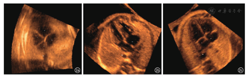 什么是超声容积探头妇产科超声影像学丨胎儿心脏超声智能导航技术显示胎儿完全型大动脉转位诊断切面的应用价值_https://www.jmylbn.com_新闻资讯_第2张