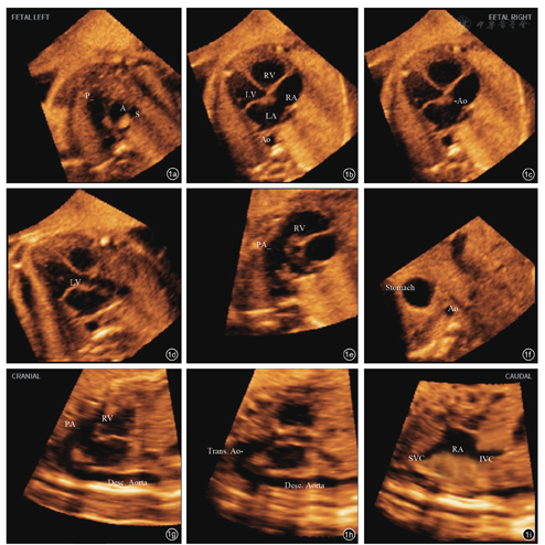 什么是超声容积探头妇产科超声影像学丨胎儿心脏超声智能导航技术显示胎儿完全型大动脉转位诊断切面的应用价值_https://www.jmylbn.com_新闻资讯_第1张