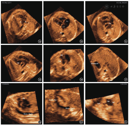 什么是超声容积探头妇产科超声影像学丨胎儿心脏超声智能导航技术显示胎儿完全型大动脉转位诊断切面的应用价值_https://www.jmylbn.com_新闻资讯_第6张