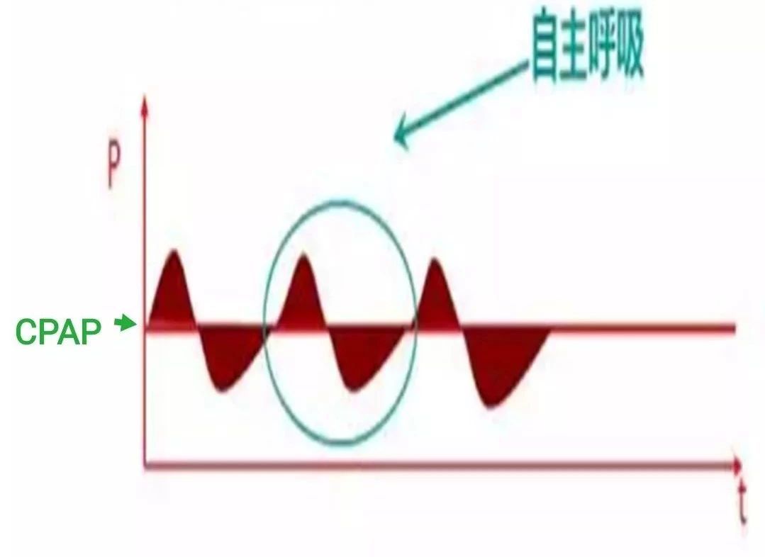 呼吸机ac是什么意思【ICU笔记】无创呼吸机不会用？看完打通任督二脉_https://www.jmylbn.com_新闻资讯_第5张