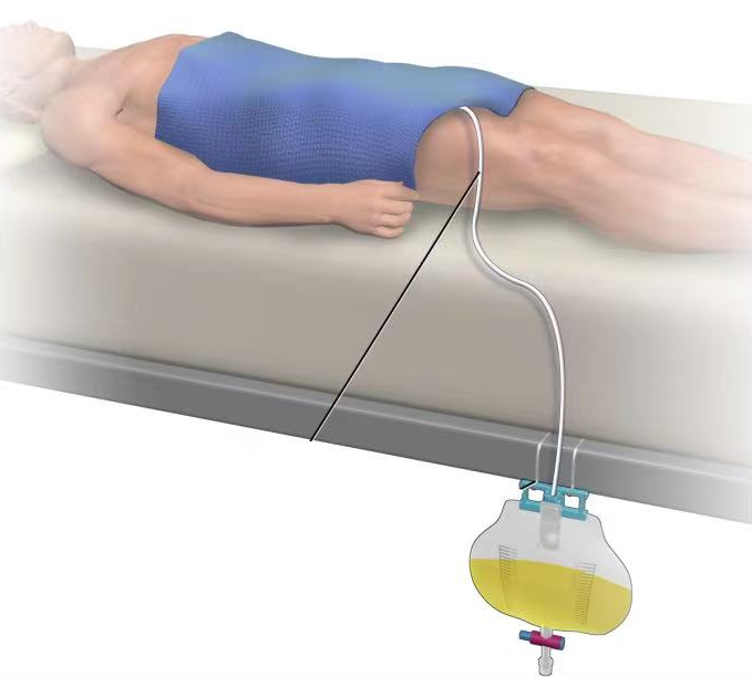 为什么要引流尿袋做手术插尿管，这种感觉“酸爽”吗，需要注意哪些问题？_https://www.jmylbn.com_新闻资讯_第10张