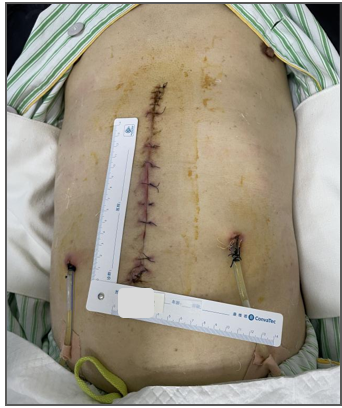 为什么负压引流科普丨VSD负压封闭引流技术，让患者创面更快痊愈_https://www.jmylbn.com_新闻资讯_第10张