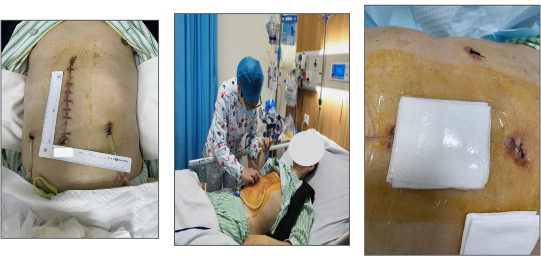 为什么负压引流科普丨VSD负压封闭引流技术，让患者创面更快痊愈_https://www.jmylbn.com_新闻资讯_第21张