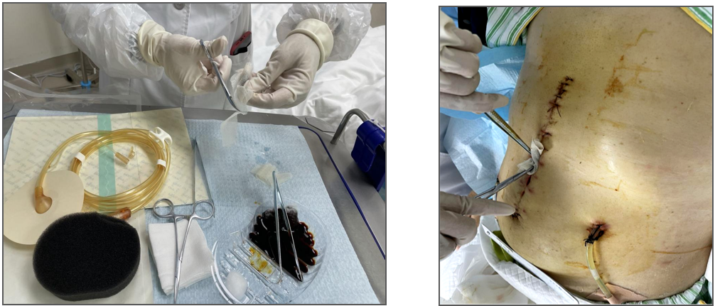 为什么负压引流科普丨VSD负压封闭引流技术，让患者创面更快痊愈_https://www.jmylbn.com_新闻资讯_第11张