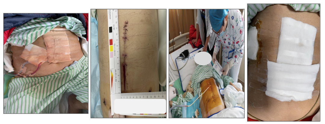 为什么负压引流科普丨VSD负压封闭引流技术，让患者创面更快痊愈_https://www.jmylbn.com_新闻资讯_第22张