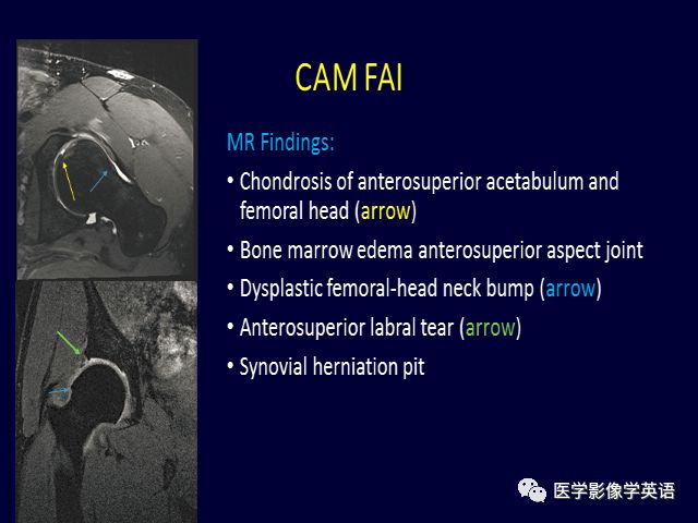 ​精彩ppt（044）：髋关节撞击综合征：外科医生想知道什么？