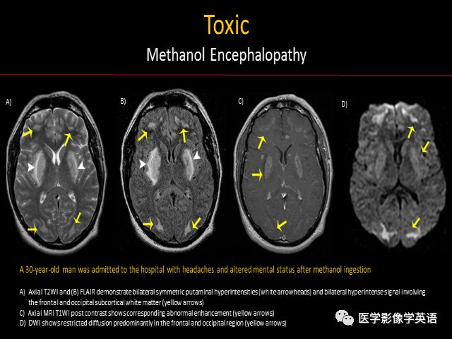 精彩ppt 032 中毒性 代谢性 自身免疫性脑病的磁共振成像 放射科医生须知 医学影像学英语 微信公众号文章阅读 Wemp