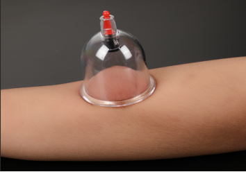 竹火罐怎么用【科普知识】生活中的安全用械科普——拔罐_https://www.jmylbn.com_新闻资讯_第3张