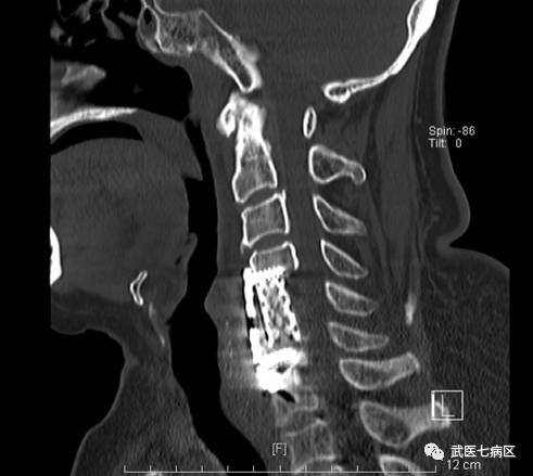 頸椎骨折典型病例